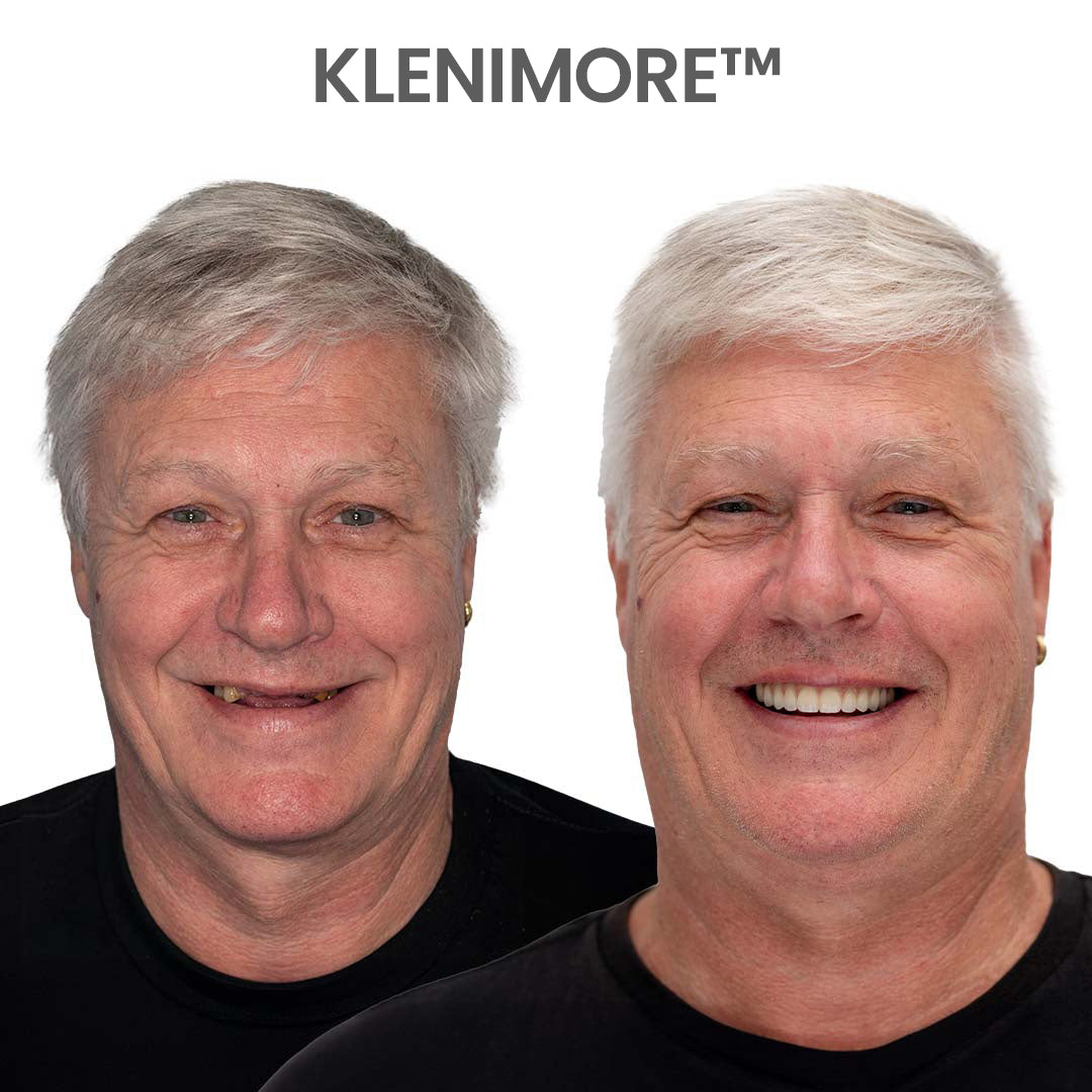 ⏰ Premium Custom Denture Set 🦷— Today's Special Offer | 😀Smile with Confidence|Buy 2 Get 1 Free