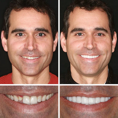 🔥Today's Special: 70% Off!(Affordable Beauty🧏‍♀️🧏‍♂️)--KLENIMORE™ --Advanced Customized Full Denture Set🦷