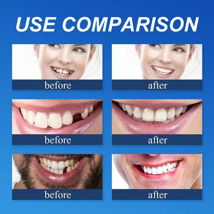 🔥Today's Special: 70% Off!(Affordable Beauty🧏‍♀️🧏‍♂️)--KLENIMORE™ --Advanced Customized Full Denture Set🦷