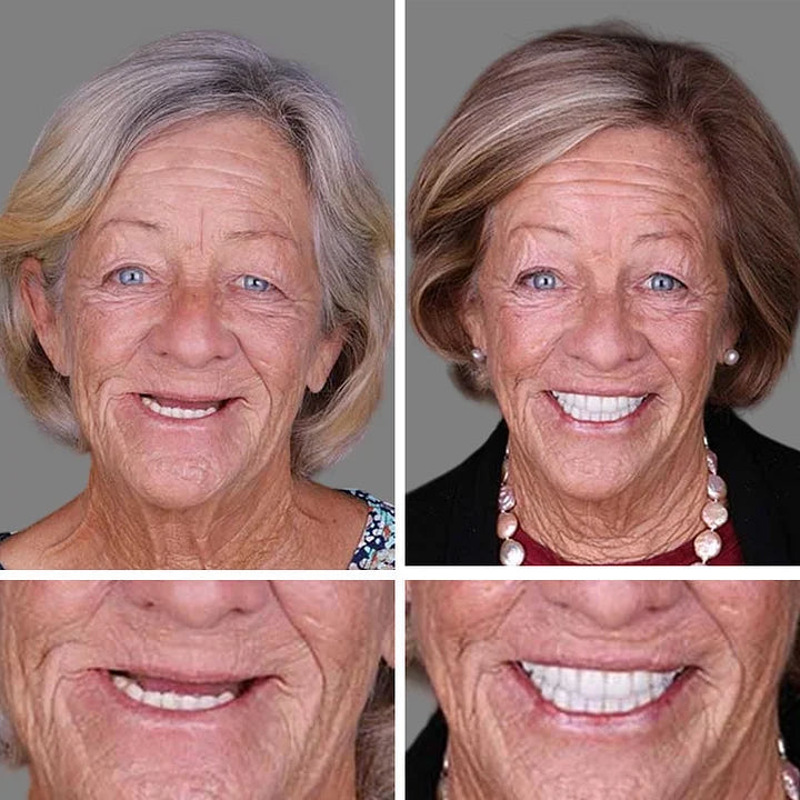 🔥Today's Special: 70% Off!(Affordable Beauty🧏‍♀️🧏‍♂️)--KLENIMORE™ --Advanced Customized Full Denture Set🦷