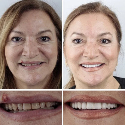 🔥Today's Special: 70% Off!(Affordable Beauty🧏‍♀️🧏‍♂️)--KLENIMORE™ --Advanced Customized Full Denture Set🦷