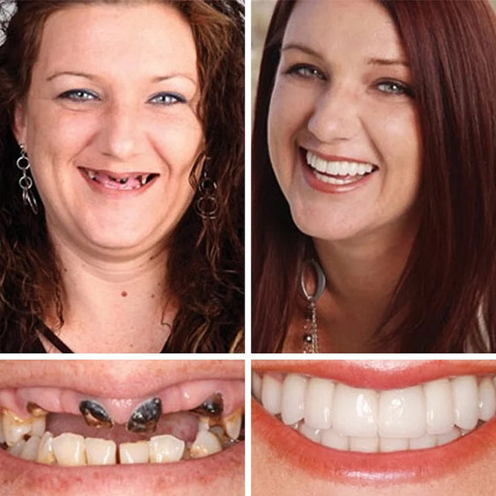 🔥Today's Special: 70% Off!(Affordable Beauty🧏‍♀️🧏‍♂️)--KLENIMORE™ --Advanced Customized Full Denture Set🦷