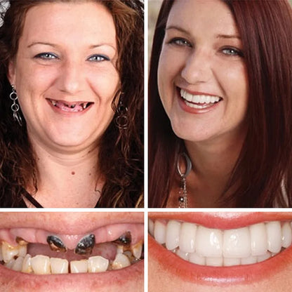 🔥Today's Special: 70% Off!(Affordable Beauty🧏‍♀️🧏‍♂️)--KLENIMORE™ --Advanced Customized Full Denture Set🦷